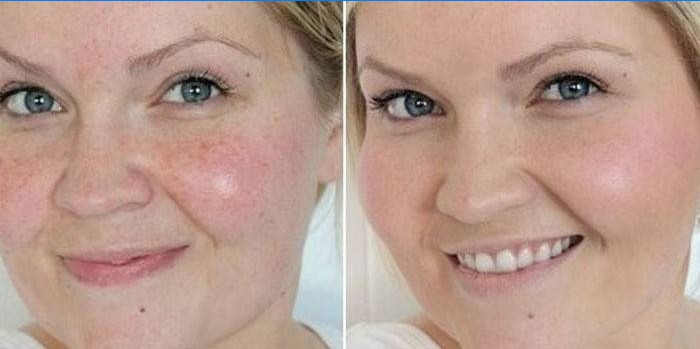Piel en la cara de una mujer antes y después de la limpieza por una esteticista