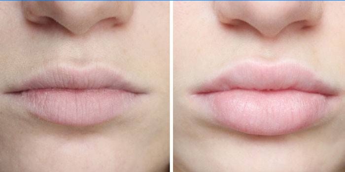 Ácido hialurónico en los labios antes y después.