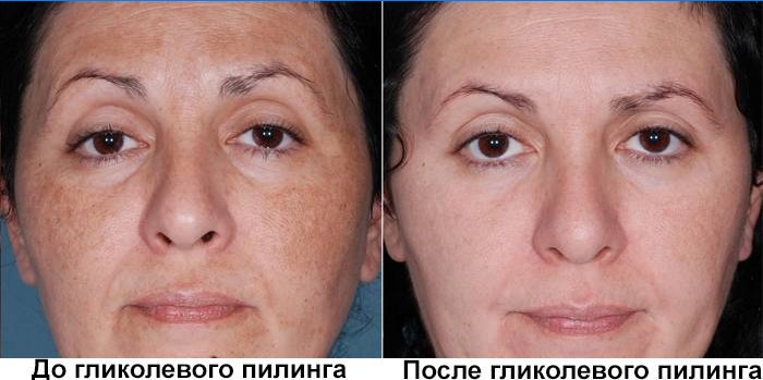 Cara antes y después del peeling glicólico