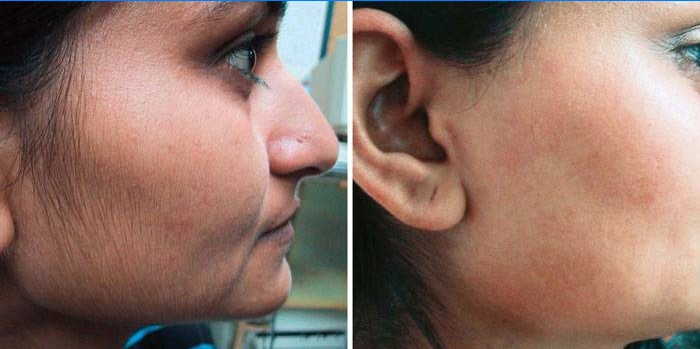 Depilación láser en la cara: fotos antes y después