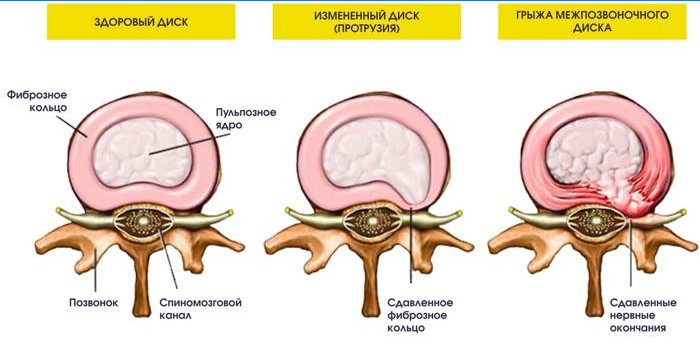 Protrusión y hernia del disco intervertebral.