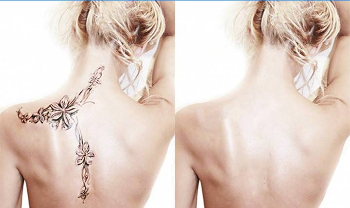Chica antes y después de la eliminación de tatuajes