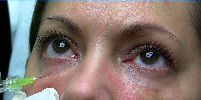 La mujer recibe una inyección debajo de los ojos