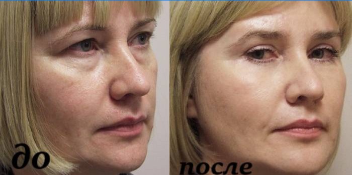 Cara antes y después de la mesoterapia.