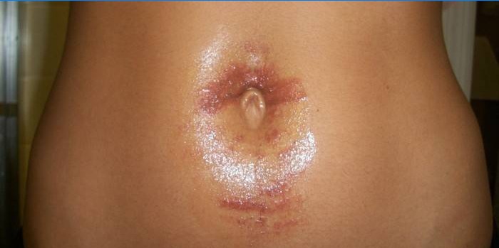 Enrojecimiento severo en la piel después de la depilación láser.