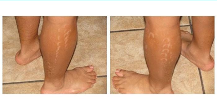 Cicatrices visibles en las piernas