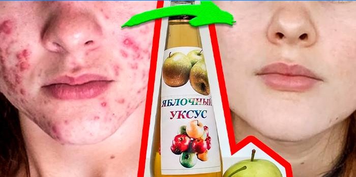 Vinagre de sidra de manzana acné