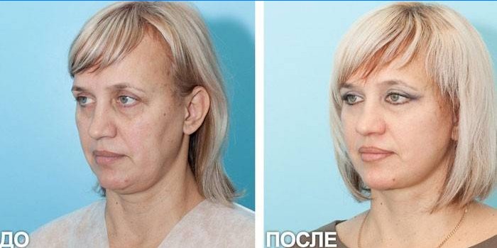Foto de una mujer antes y después del levantamiento SMAS